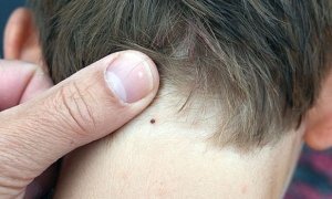 Более 93 тысяч россиян обратились за помощью в больницы из-за укусов клещей